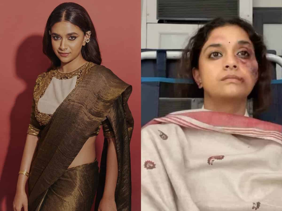 Pics of Keerthy Suresh's injured face with bruises go viral