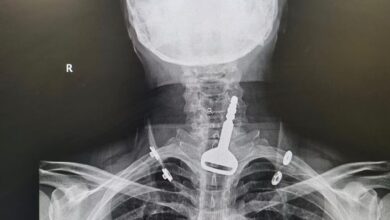 Saudi Arabia: 49-yr-old man who swallowed car key saved