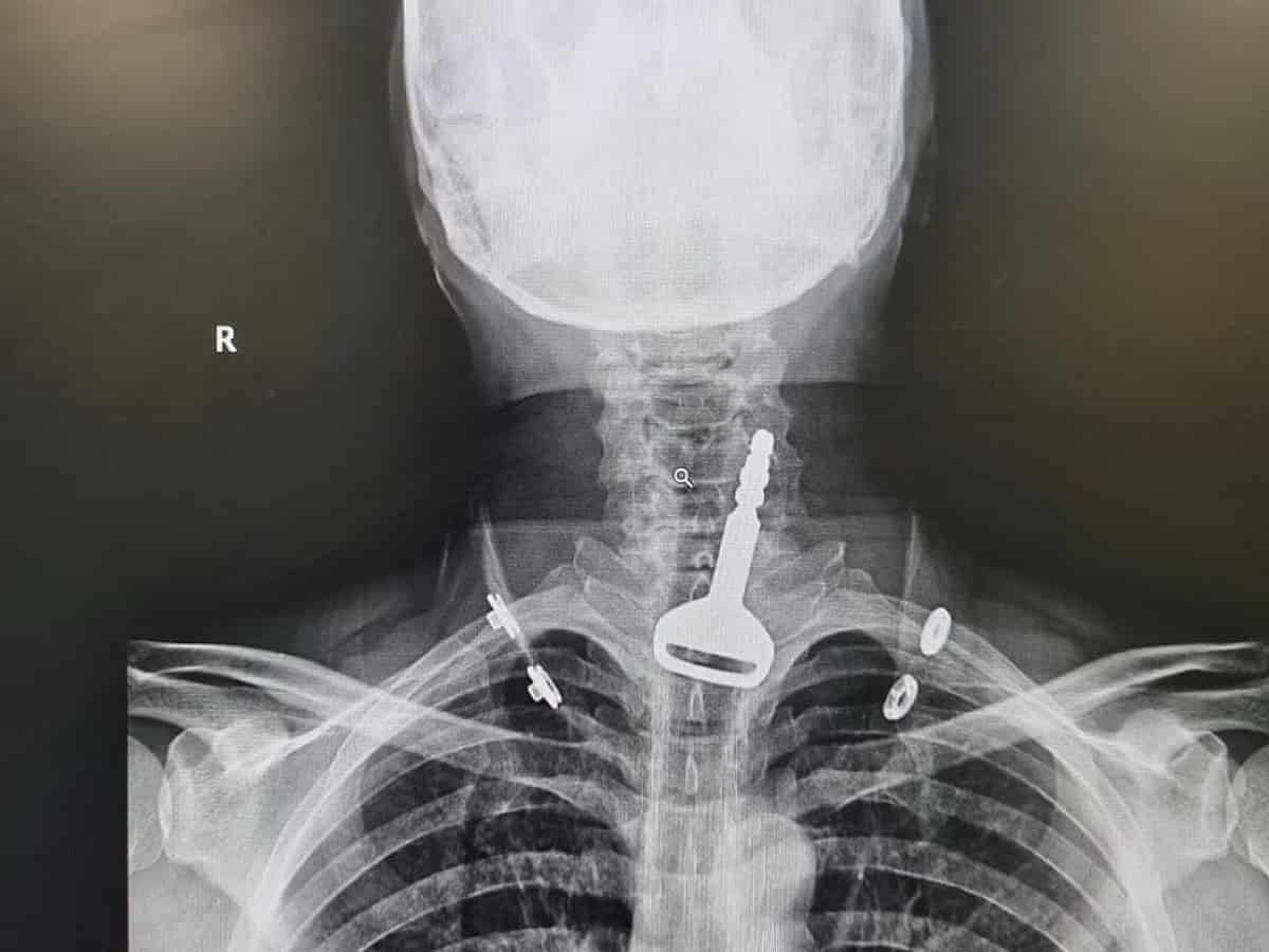 Saudi Arabia: 49-yr-old man who swallowed car key saved