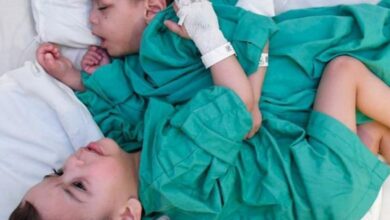 Saudi: Syrian conjoined twins successfully separated in over 7-hr surgery (Video)