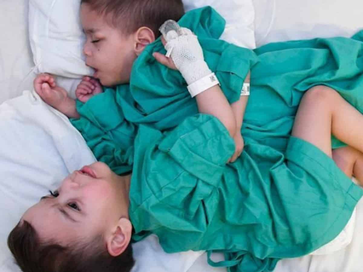 Saudi: Syrian conjoined twins successfully separated in over 7-hr surgery (Video)