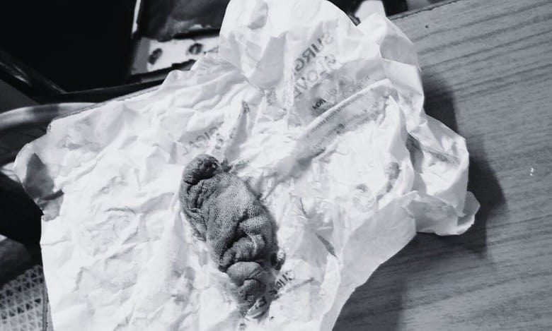 Telangana: Doctors forget cotton pad in womb; remove after 5 days