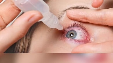 Conjunctivitis soaring in Hyderabad: Tips to prevent pink eye