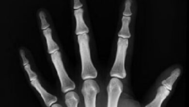 Signs that indicate your bones are weak