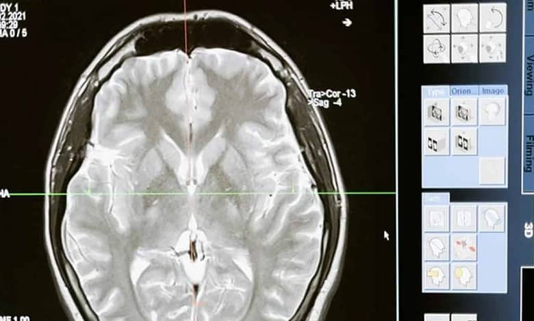 8-cm live worm removed from woman's brain in world's 1st discovery