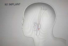 Neuralink now recruiting human trial of its brain-computer