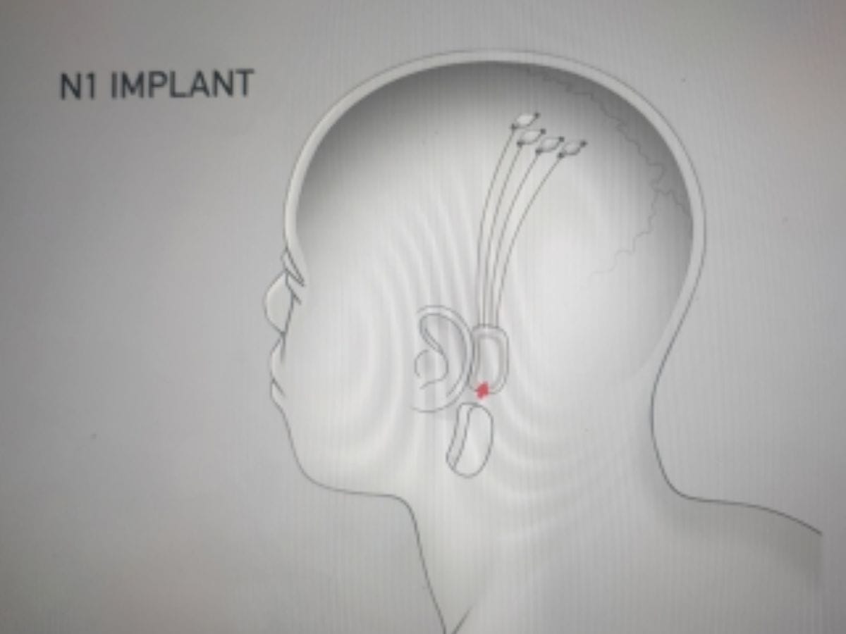 Neuralink now recruiting human trial of its brain-computer