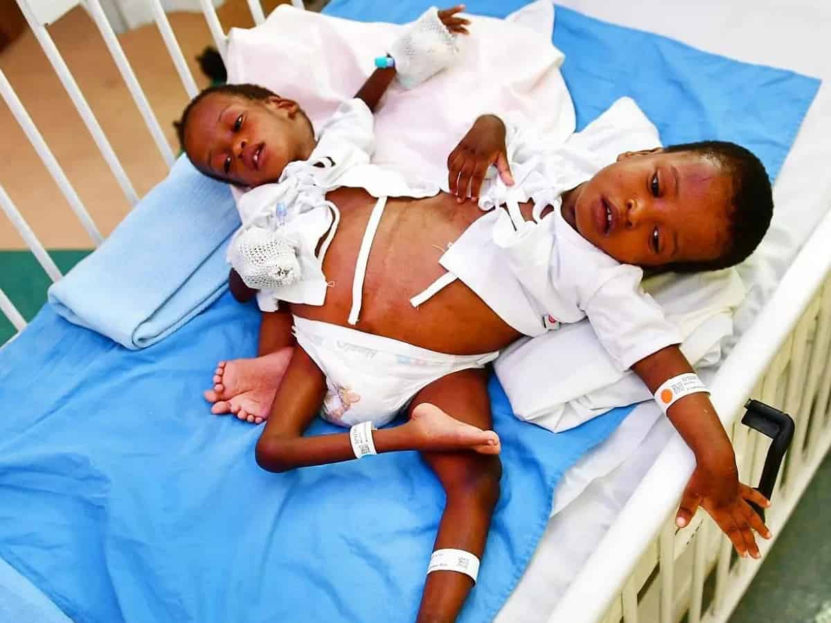 Saudi Arabia: 16-hr-surgery to separate conjoined Tanzanian twins begins