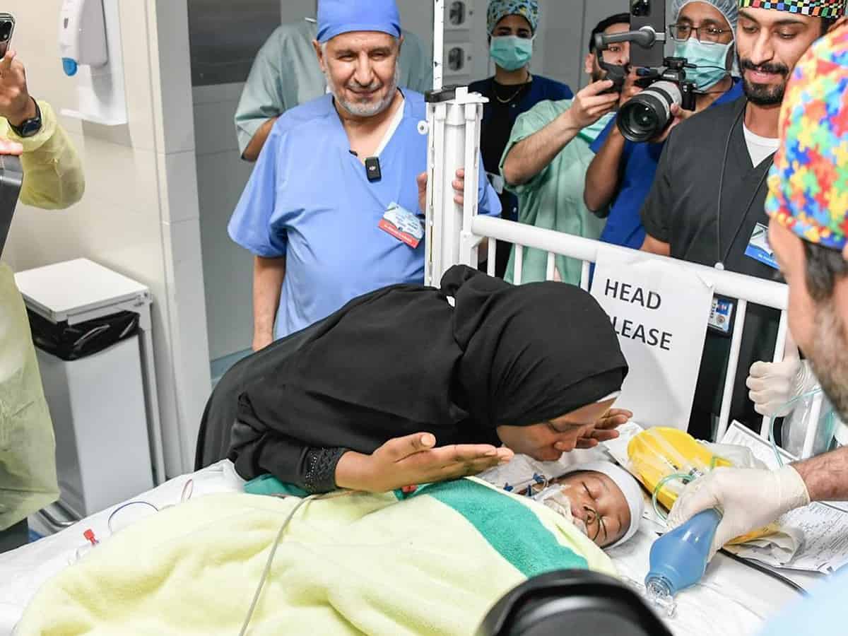 Saudi: Tanzanian conjoined twins successfully separated in 16-hr surgery
