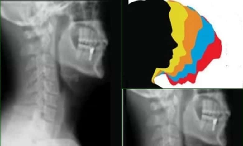 Rising ‘text-neck syndrome’ accounts for 70% OPD visits: Doctors