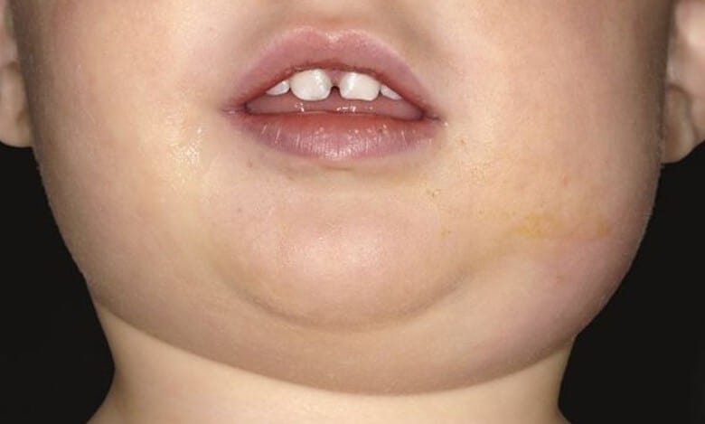Expert flags rising mumps cases in Hyderabad’s Old City