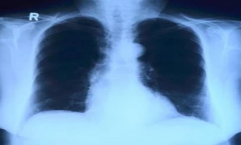 New AI tool can detect Covid infection from chest X-rays 98% accuracy