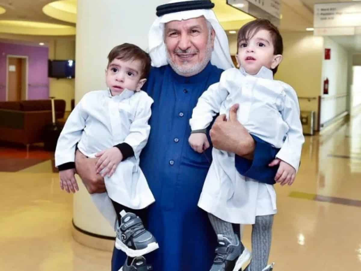 Saudi doctor meets Iraqi conjoined twins one year after their separation