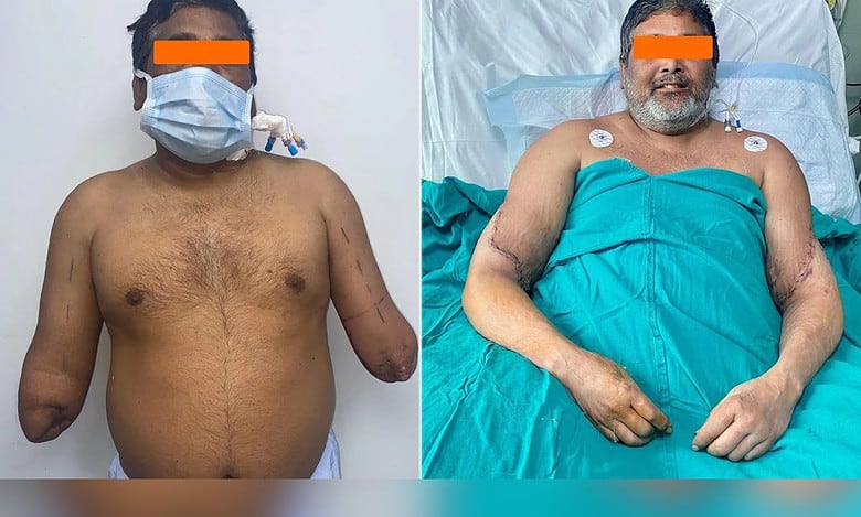 Delhi painter to hold brush again thanks to organ donation, doctors' efforts