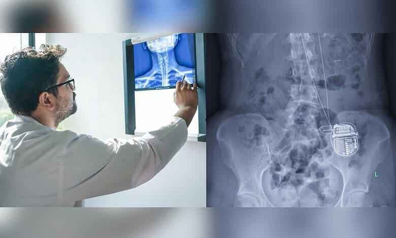 Hyderabad: AIG conducts Asia's 1st high cervical spinal cord stimulator implantation