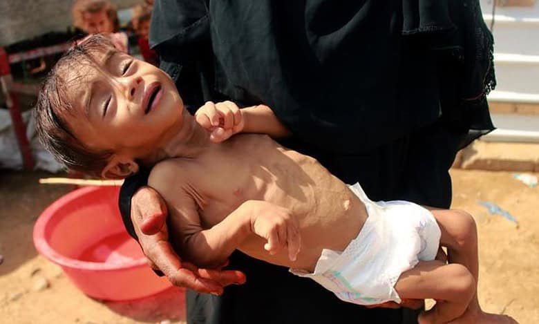 Spike in child malnutrition across Yemen's gov't-controlled areas: UN