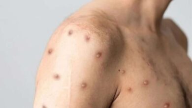Mpox Rashes