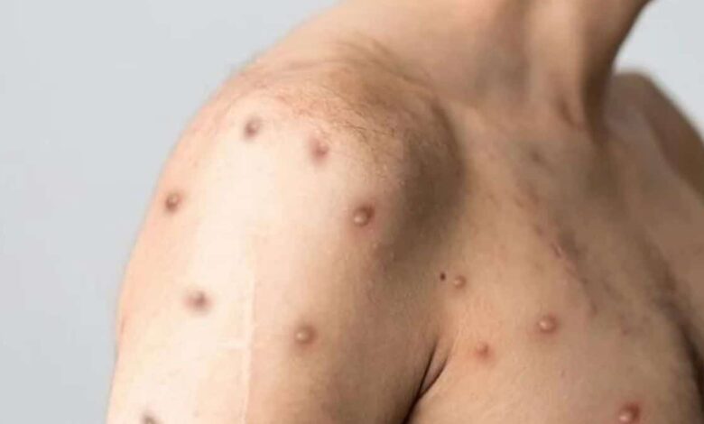 Mpox Rashes