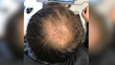 Panic in 3 villages of Maha as mass hair loss makes residents bald