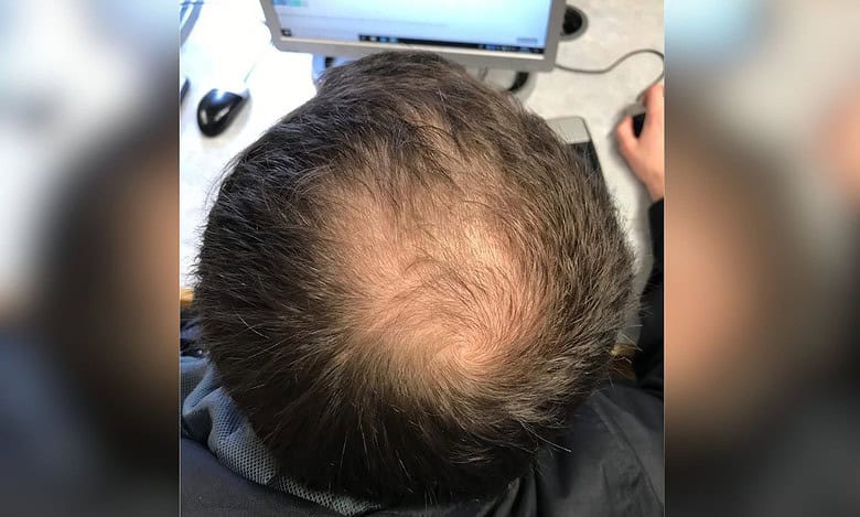 Panic in 3 villages of Maha as mass hair loss makes residents bald