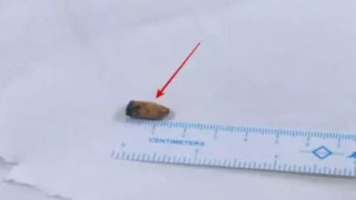 Hospital in Hyderabad removes pen cap from man's lung after 21 yrs