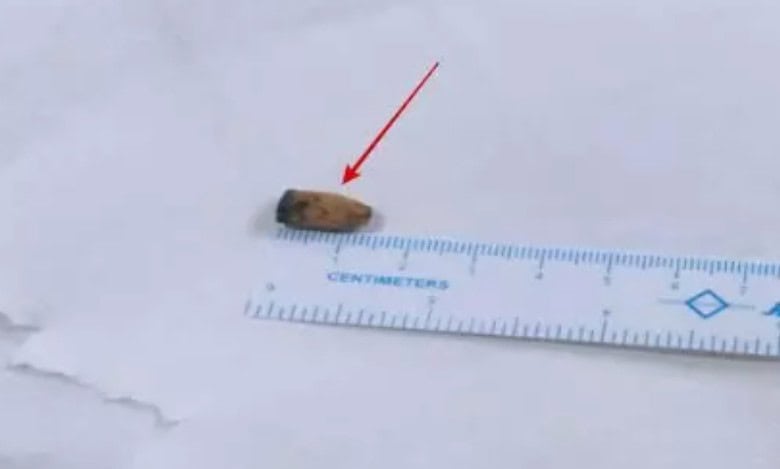 Hospital in Hyderabad removes pen cap from man's lung after 21 yrs