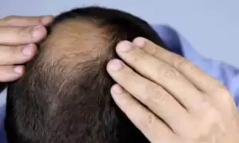 Maha hair loss cases: Expert report blames high selenium in wheat
