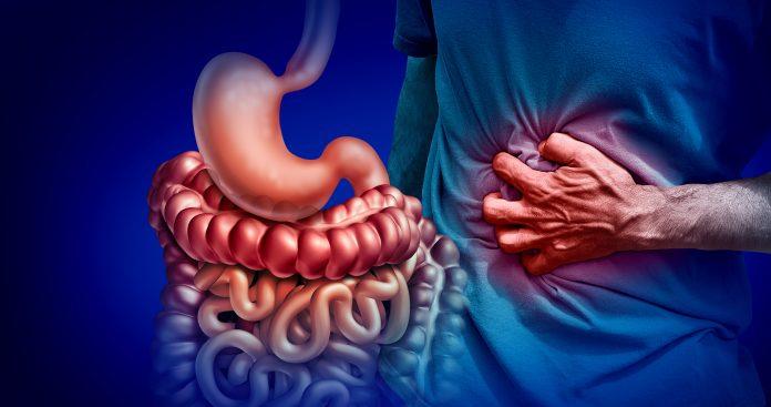 A representationa image depicting Inflammatory Bowel Disease