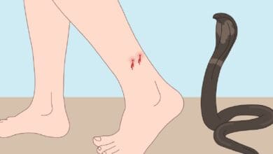 A cartoon image shows a human ankle with two red bite marks and a small amount of blood, next to a coiled cobra with its hood raised, against a beige ground and blue sky. Explain snakebite first aid Different venomous snakes