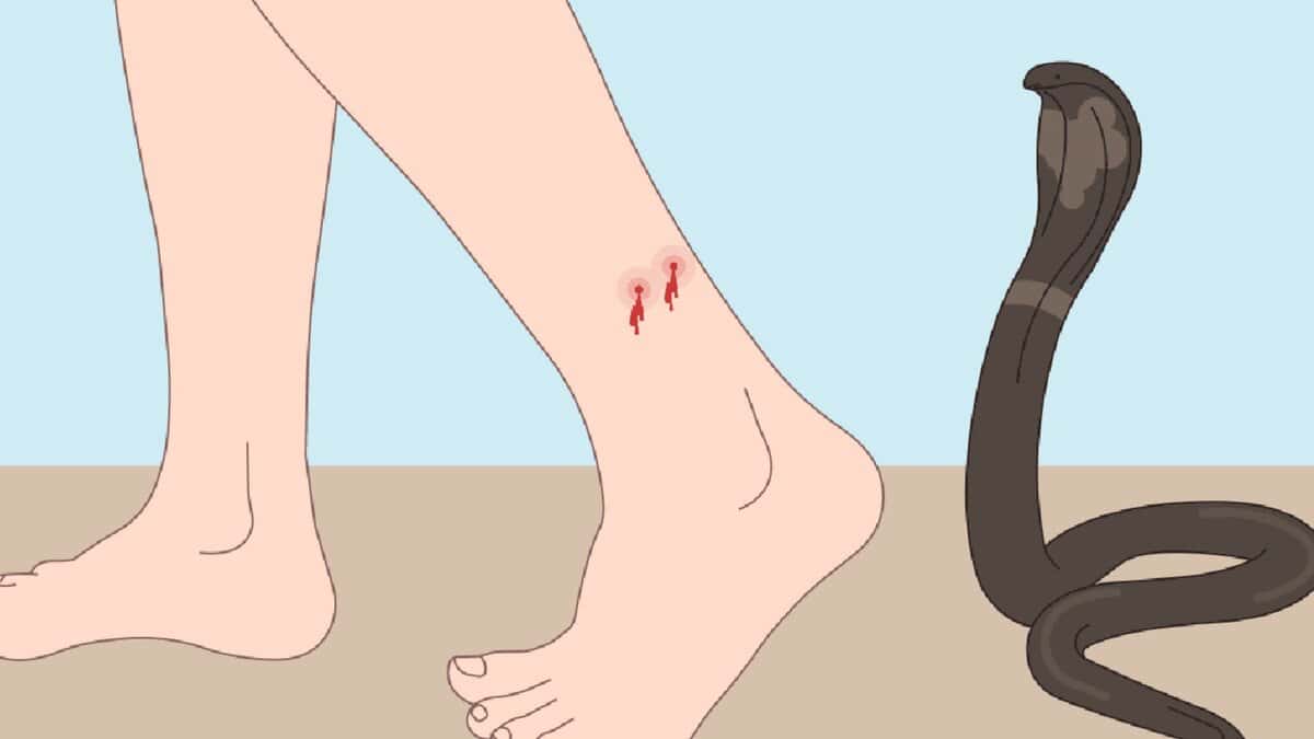 A cartoon image shows a human ankle with two red bite marks and a small amount of blood, next to a coiled cobra with its hood raised, against a beige ground and blue sky. Explain snakebite first aid Different venomous snakes