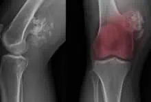 Bone cancer
