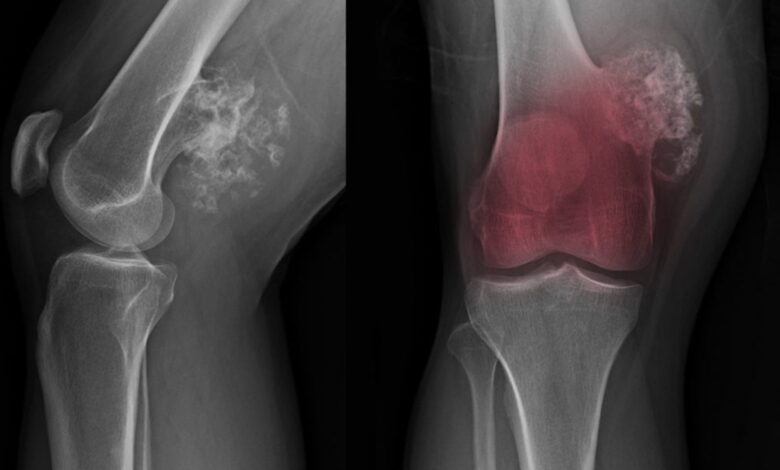 Bone cancer