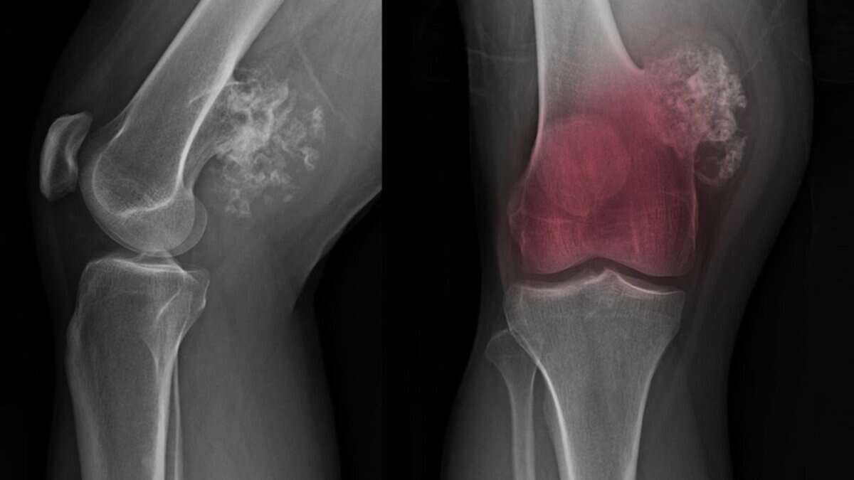 Bone cancer