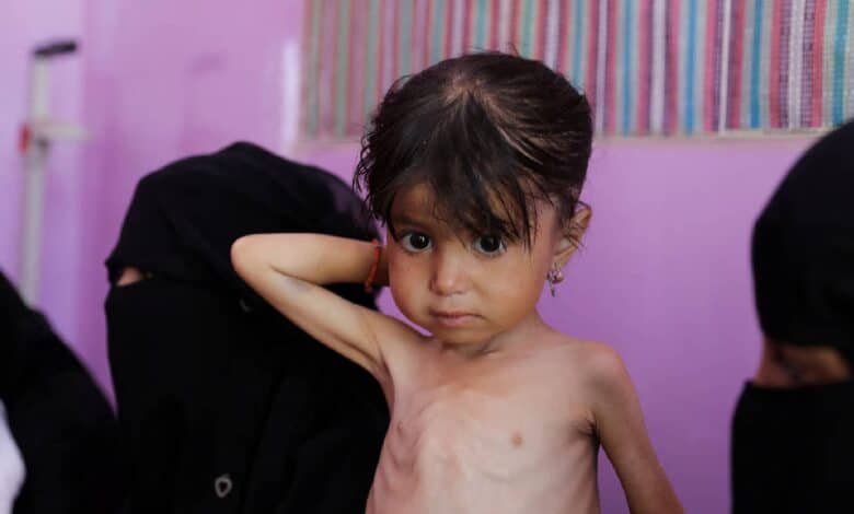 The image of a young girl suffering from acute malnutrition.