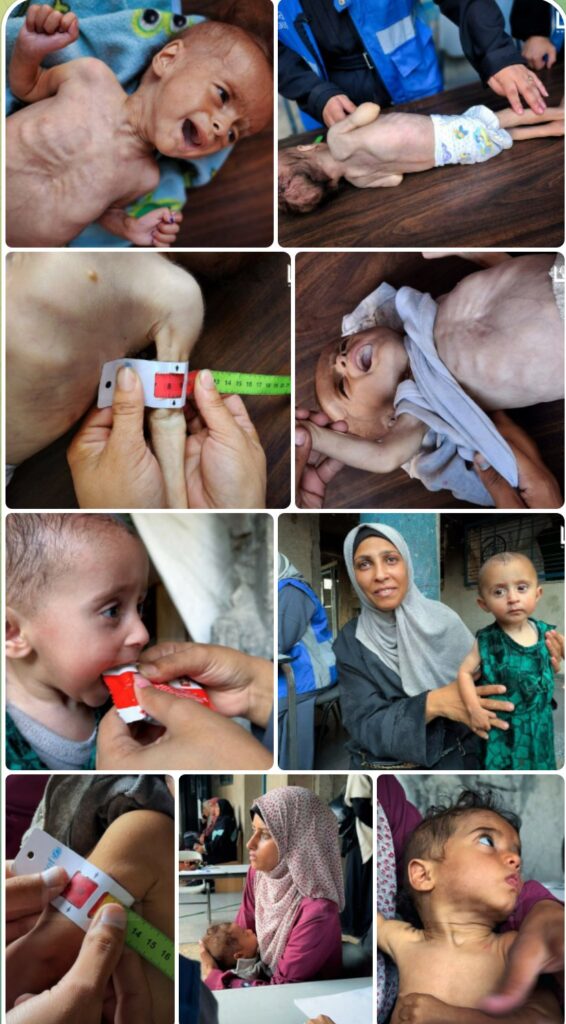 Palestinian children, showing signs of malnutrition, undergo medical examinations at a UNRWA clinic in Gaza City.