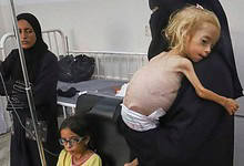 Islam Qudeih holds her severely malnourished shirtless, 2-year-old daughter, Shamm, at Nasser Hospital in Khan Younis, southern Gaza Strip. (Photo | AP)