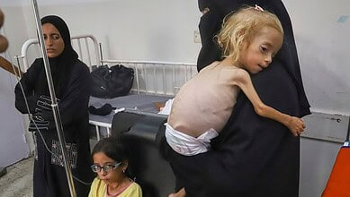 Islam Qudeih holds her severely malnourished shirtless, 2-year-old daughter, Shamm, at Nasser Hospital in Khan Younis, southern Gaza Strip. (Photo | AP)