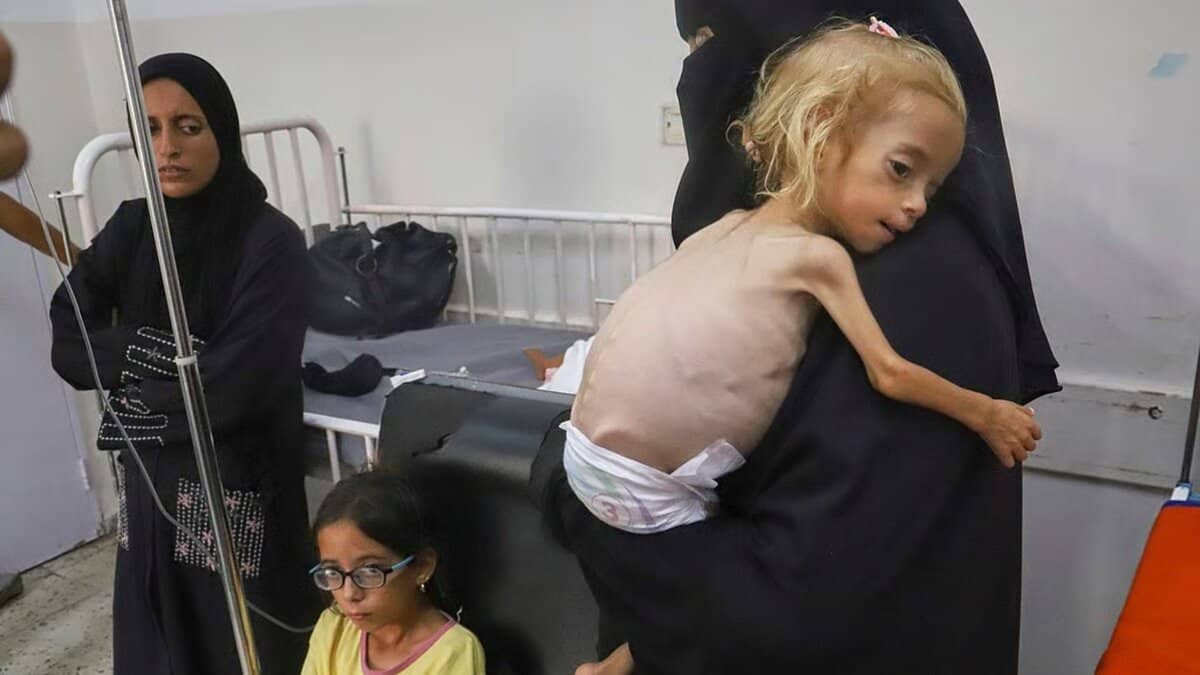 Islam Qudeih holds her severely malnourished shirtless, 2-year-old daughter, Shamm, at Nasser Hospital in Khan Younis, southern Gaza Strip. (Photo | AP)