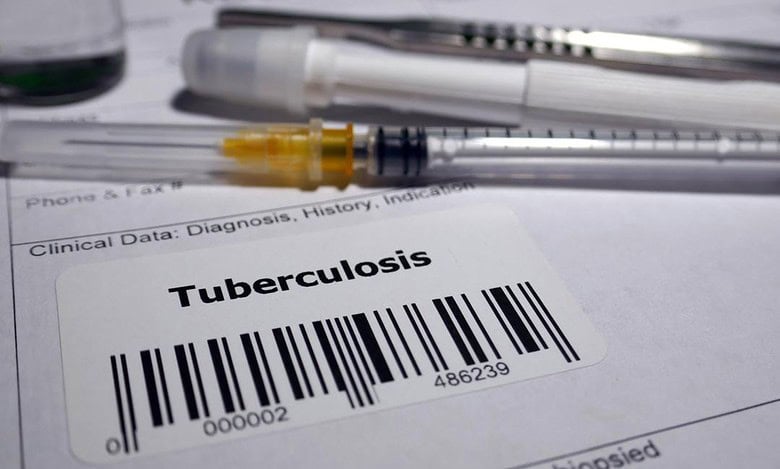 Tuberculosis