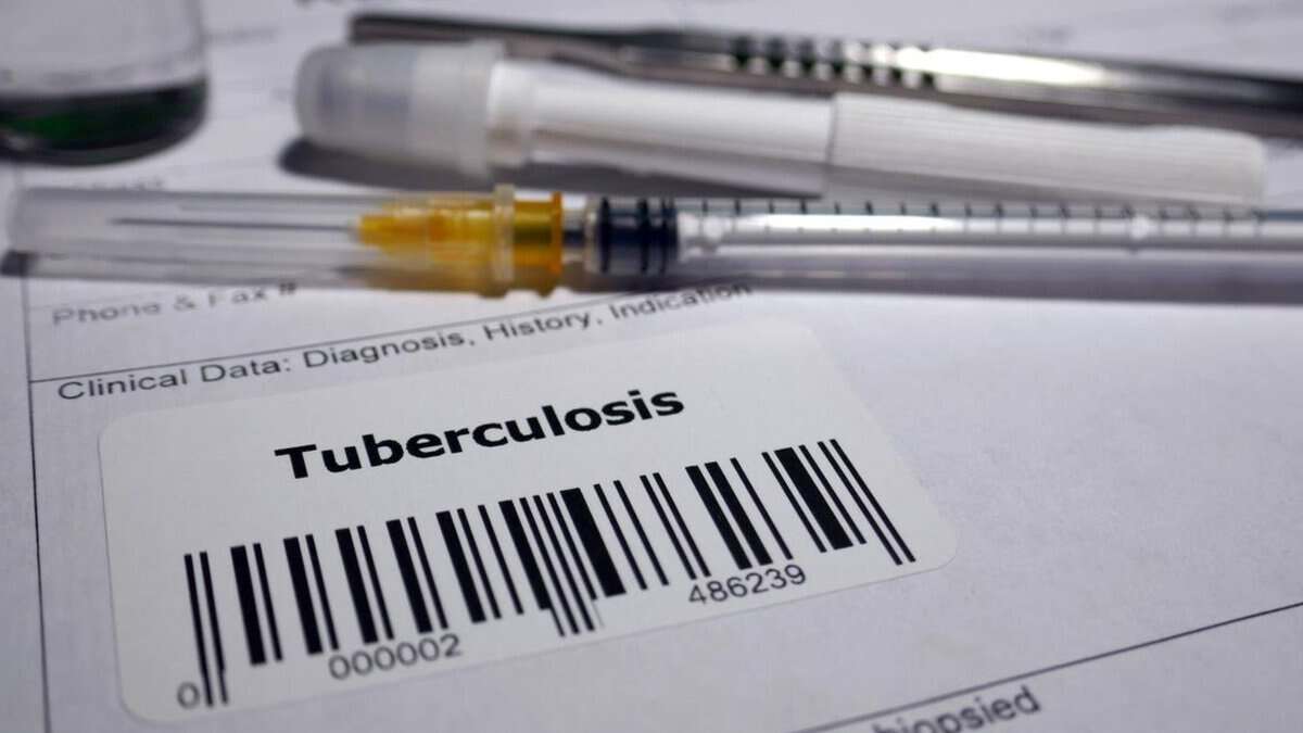 Tuberculosis