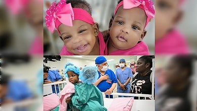 A collage showing Jamaican conjoined twins Azaria and Azura Elson before their separation surgery, including close-up and hospital preparation images.