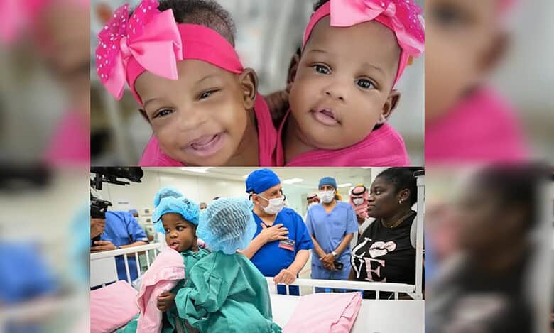 A collage showing Jamaican conjoined twins Azaria and Azura Elson before their separation surgery, including close-up and hospital preparation images.
