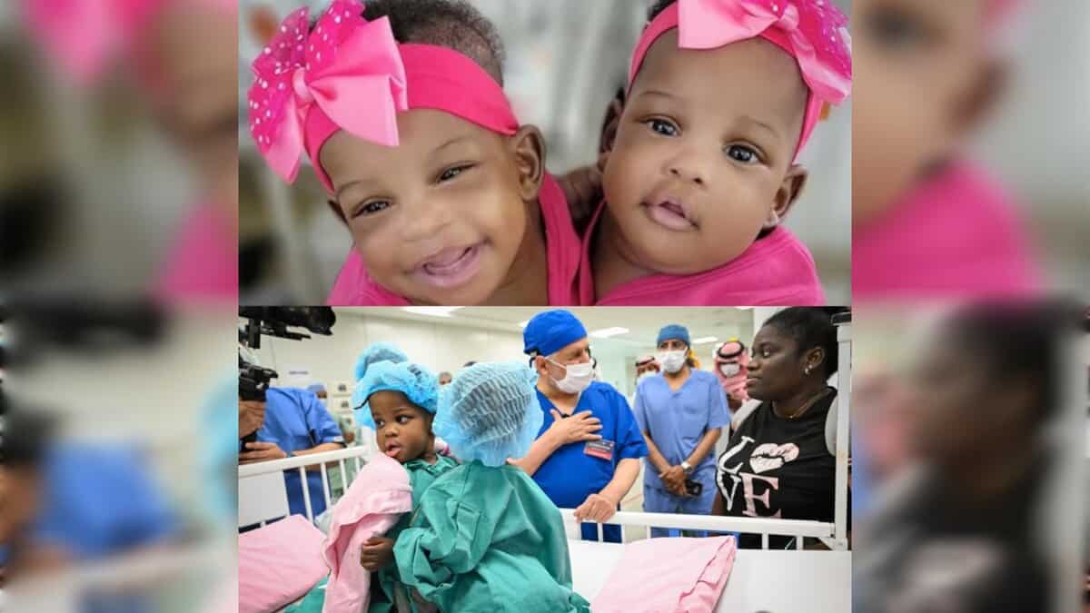 A collage showing Jamaican conjoined twins Azaria and Azura Elson before their separation surgery, including close-up and hospital preparation images.