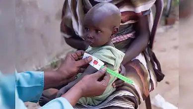 A health worker measures the arm of a malnourished child in Sudan.