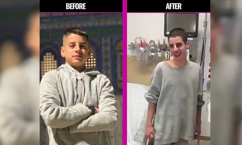 Side-by-side images of Mohammed Zaher Ibrahim: on the left, a healthy teenage boy standing with folded arms; on the right, the same boy after release from Israeli detention, visibly thinner with a shaved head, standing in a hospital room.