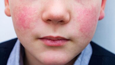 Image showing a child with a rash on his cheeks
