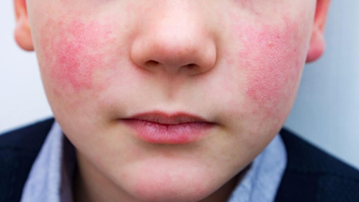 Image showing a child with a rash on his cheeks