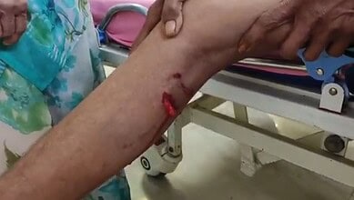 Dog bites 25 people in Rajanna Sircilla's Vemulawada town