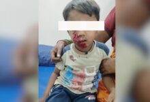 Four-year-old attacked by stray dog while playing in Telangana's Nalgonda