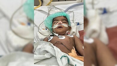 Infant patient after a rare liver transplant at Osmania General Hospital, Hyderabad.
